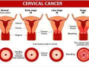 Cervical cancer: FG commences second phase of HPV vaccination in May 2024 Cervical Cancer