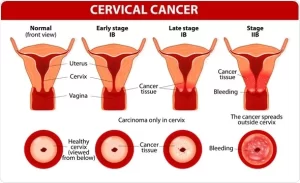 Cervical Cancer