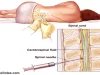 NCDC: cerebrospinal Meningitis