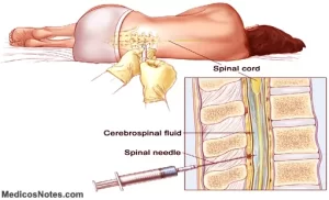 NCDC: cerebrospinal Meningitis